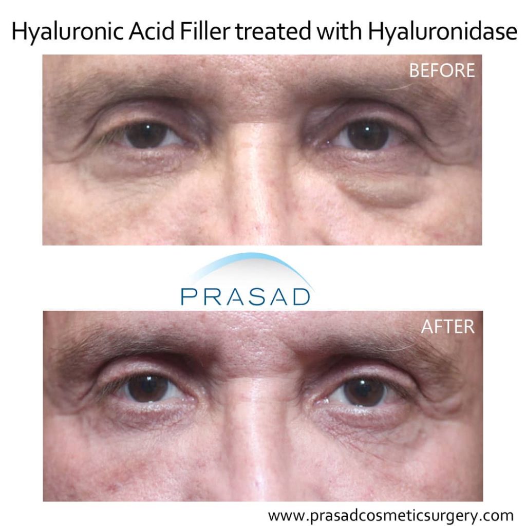 fillers gone wrong treated with hyaluronidase before and after
