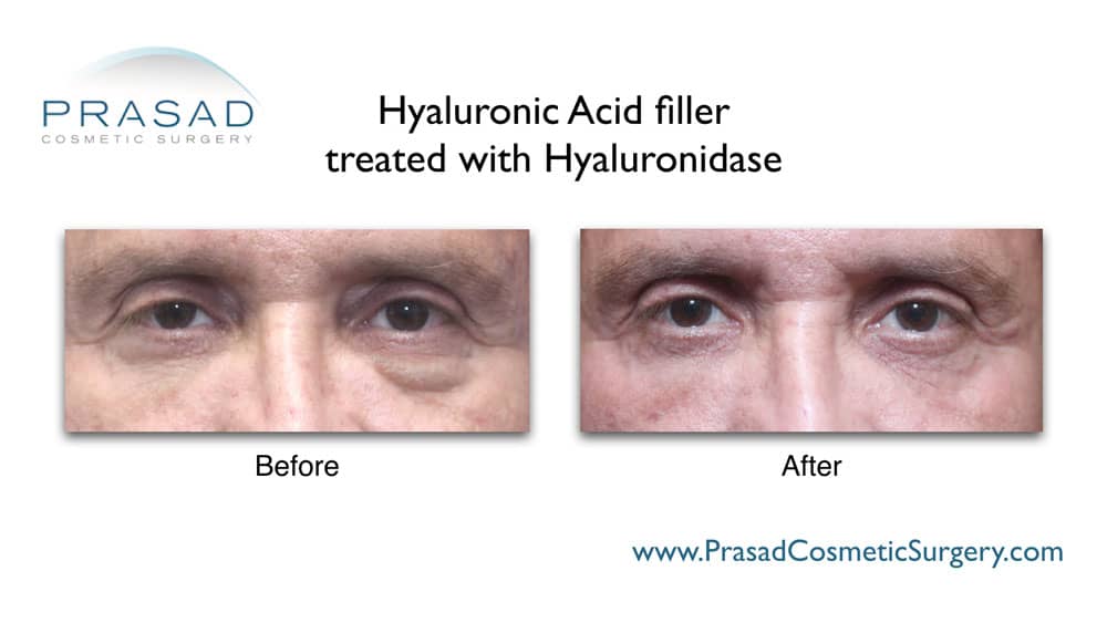 under eye fillers gone wrong treated with hyaluronidase before and after