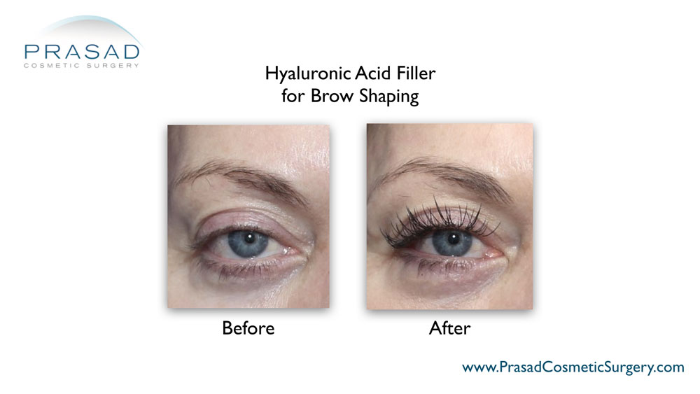 brow lift before and after filler by Dr. Prasad Manhattan NYC