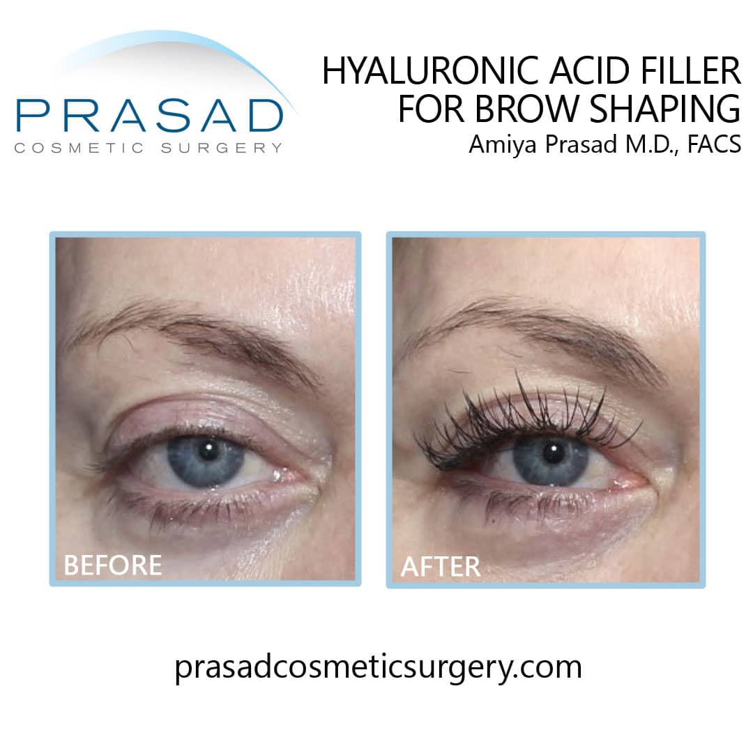 Fillers for brow lift before and after by Dr. Prasad NYC