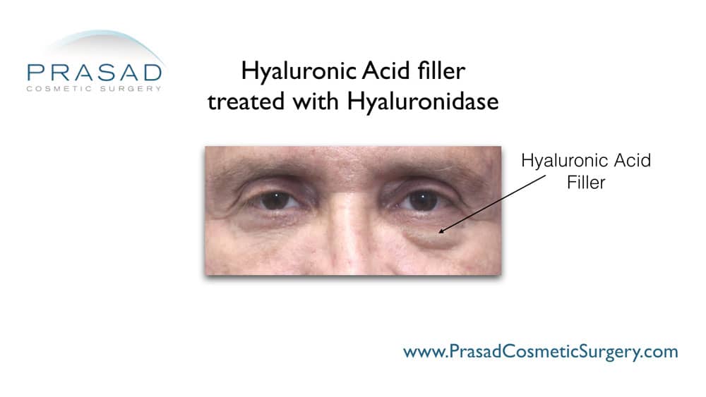 face fillers gone wrong treated with hyaluronidase