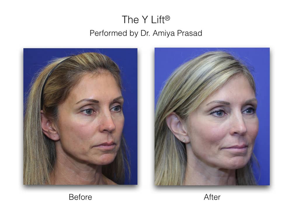 y lift before and after performed by Dr Prasad NYC
