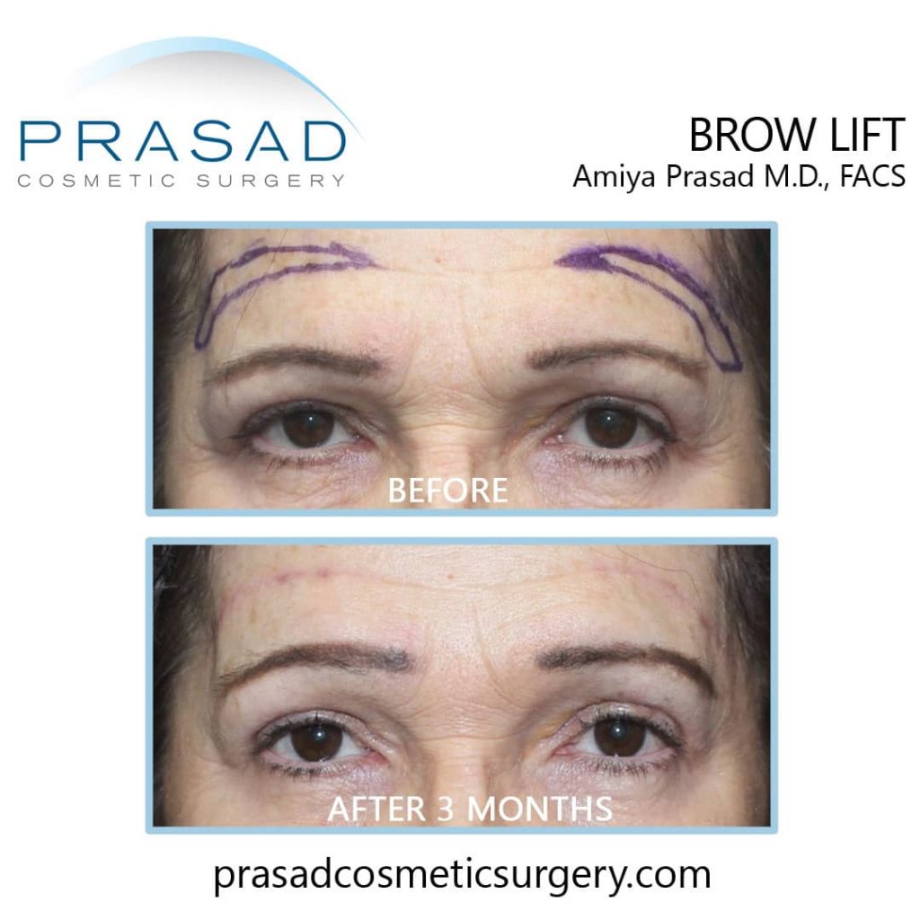 markings for brow lift surgery before and after