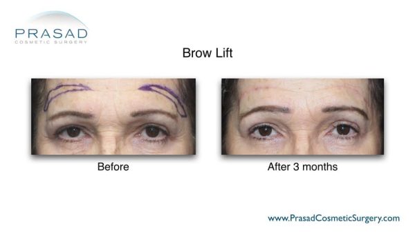 Brow Lift Before and After Photos | Manhattan and Long Island NY