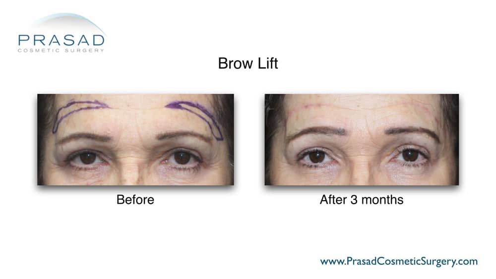 markings for brow lift surgery before and after 3 months recovery