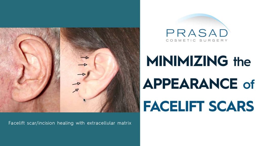 minimizing the appearance of facelift scars