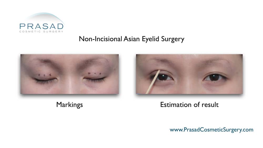 Asian eyelid crease estimation