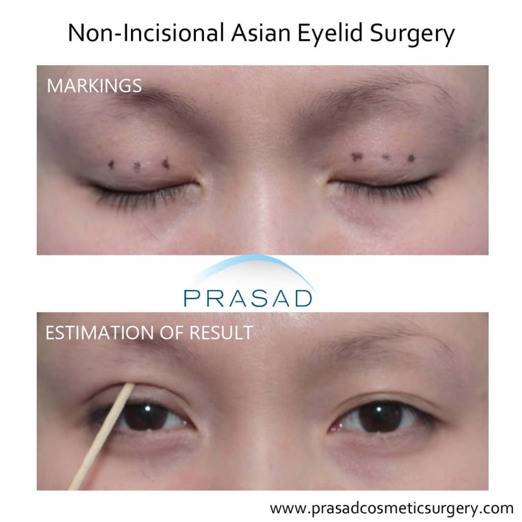 non-incisional Asian eyelid crease estimation