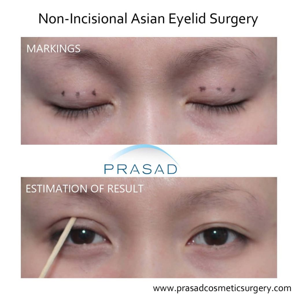 Incisional on sale eyelid surgery