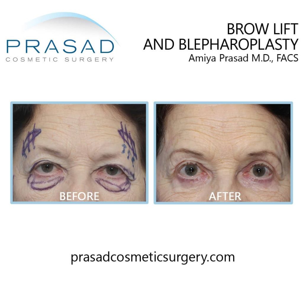 skin markings for brow lift and eyelid surgery