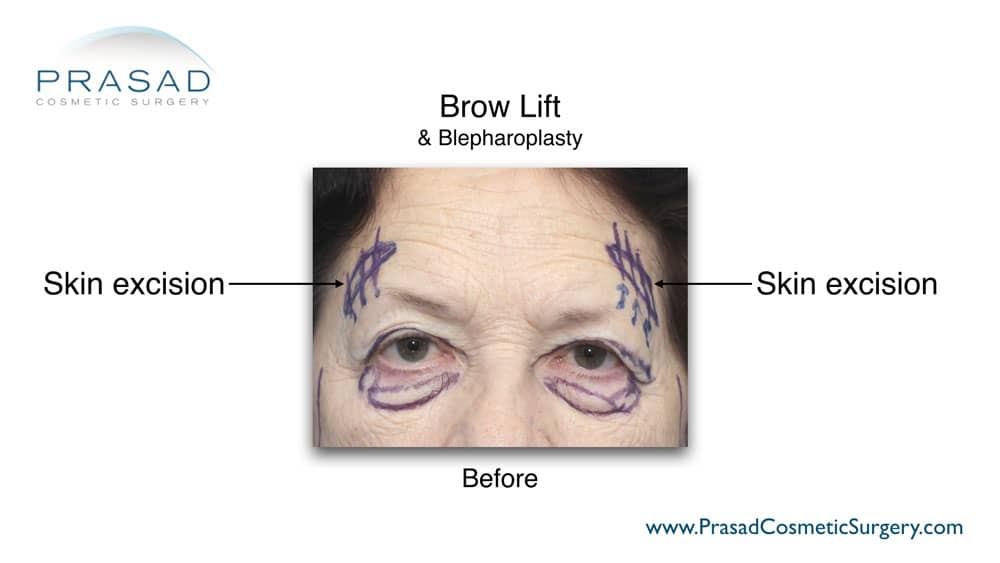 skin markings for brow lift and blepharoplasty