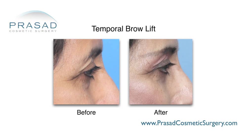 brow lift before and after surgery by Dr. Prasad Manhattan NYC