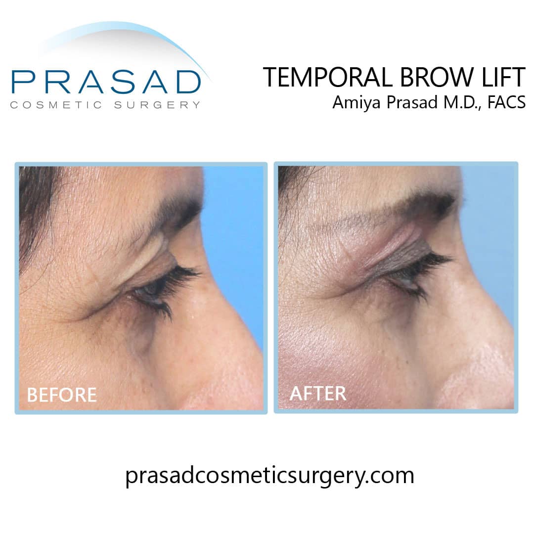 Surgical brow lift before and after by Dr. Prasad Long Island, NY