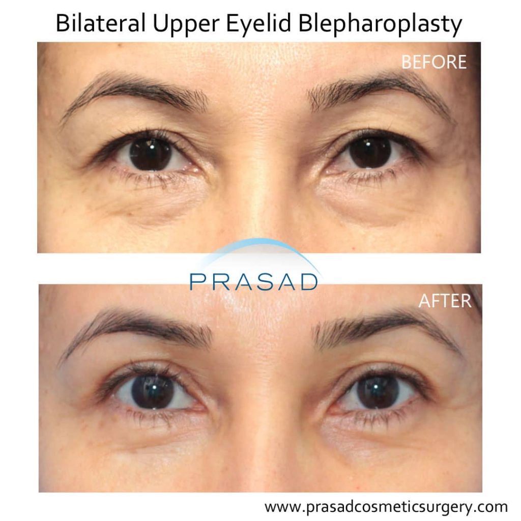 upper and lower eyelid blepharoplasty before and after Long Island, NY
