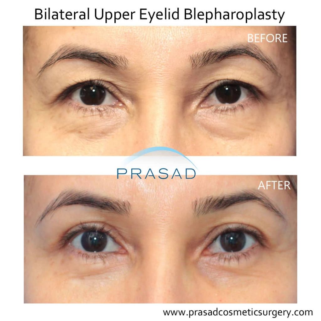 Asymmetrical Eyes - When Surgery is Recommended | Dr. Prasad