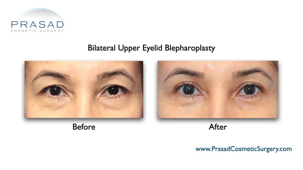 upper and lower eyelid blepharoplasty before and after Manhattan, NYC