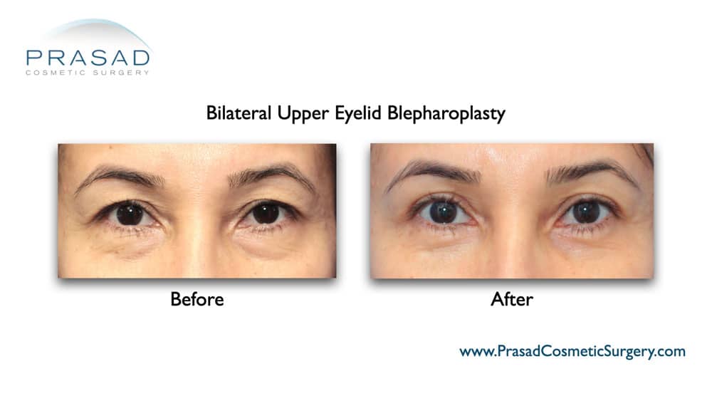 Asymmetrical Eyes - When Surgery is Recommended | Dr. Prasad