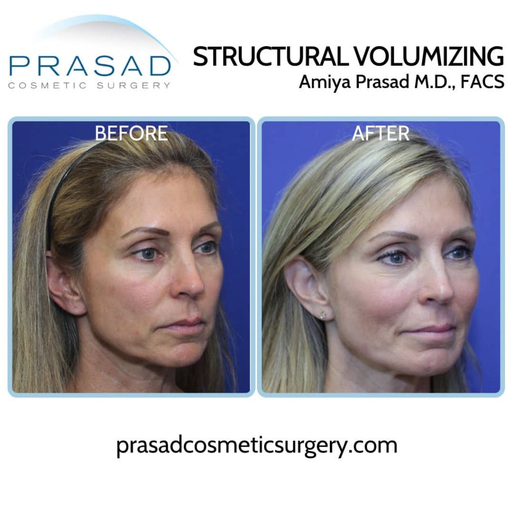 y lift before and after performed by Dr Prasad New York City