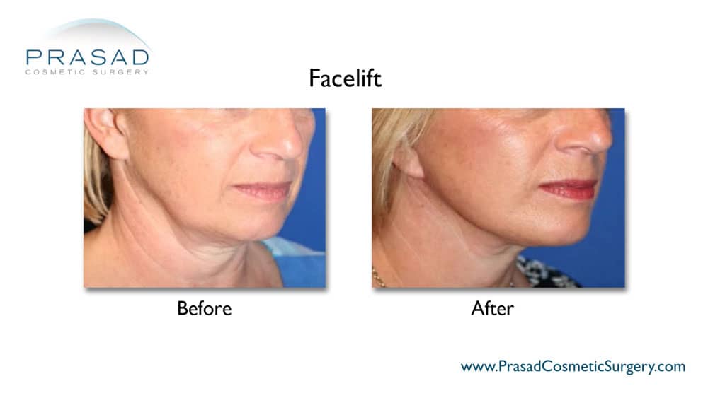 surgical treatment for jowls before and after