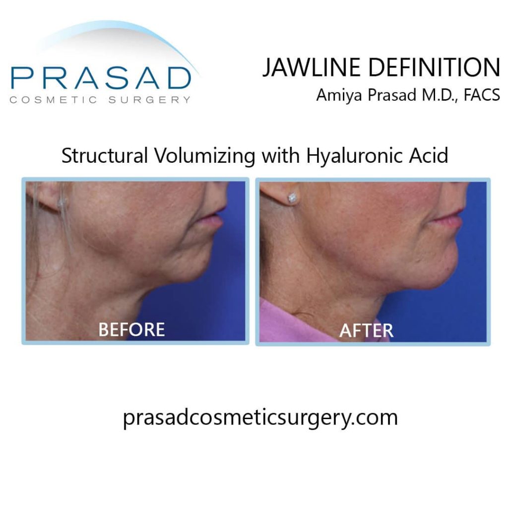 jawline filler before and after