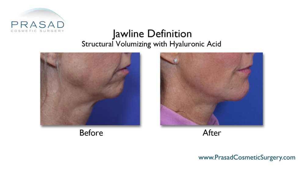 jawline filler before and after Manhattan NYC