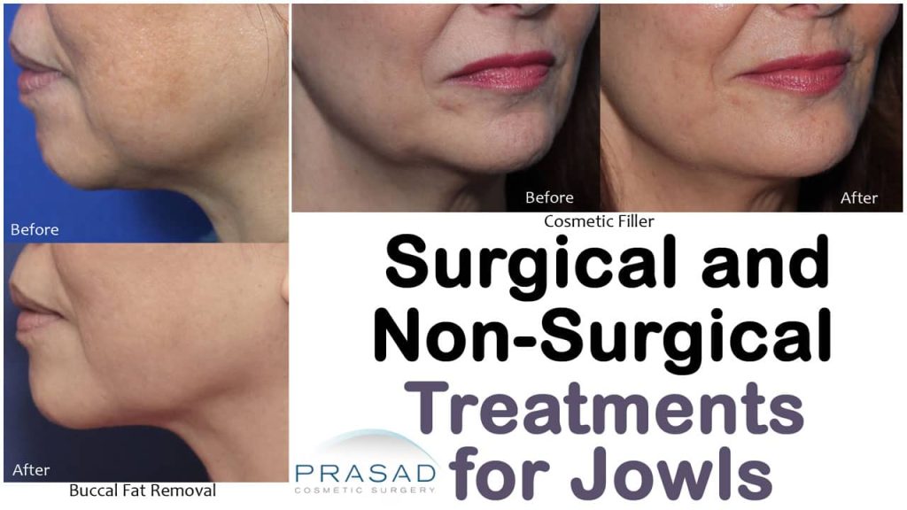 what is the best treatment for sagging jowls?