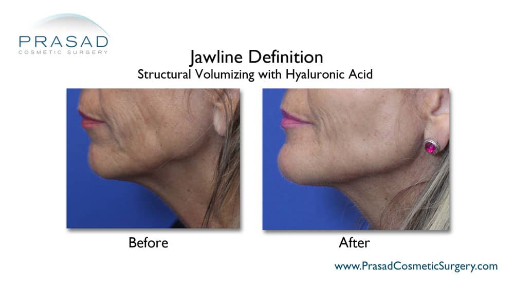 jawline filler before and after Long Island, New York