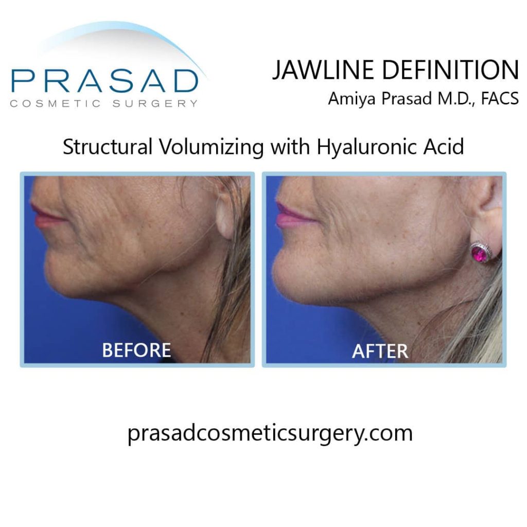 jawline filler before and after Garden City, Long Island
