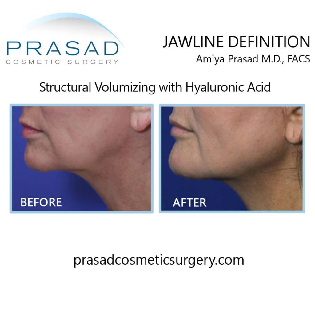filler to lift jowl before and after