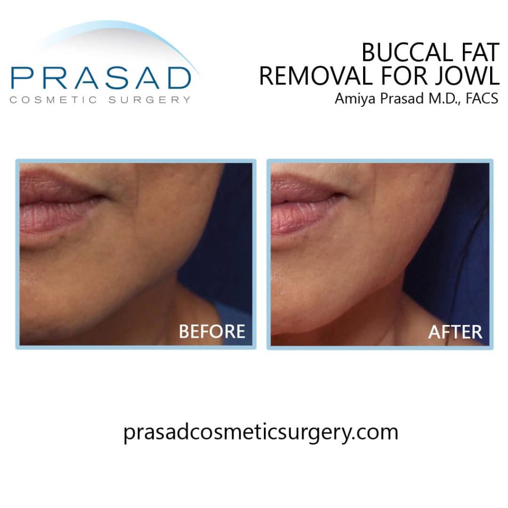Buccal fat removal before and after Manhattan NYC