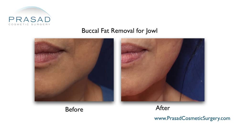 Buccal fat removal before and after Garden City, Long Island