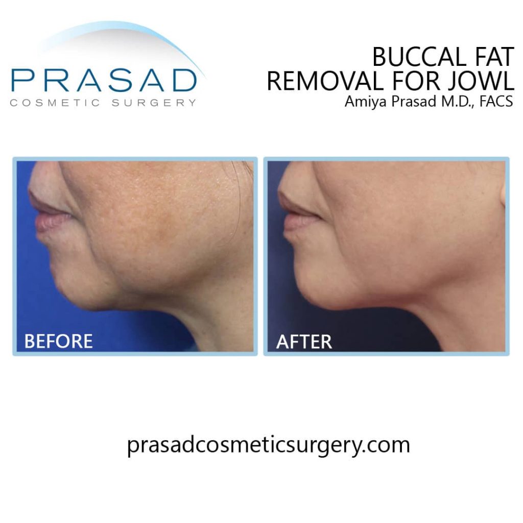 Buccal fat removal before and after procedure done by Dr. Amiya Prasad