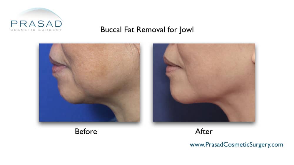 Buccal fat removal before and after New York City, NY
