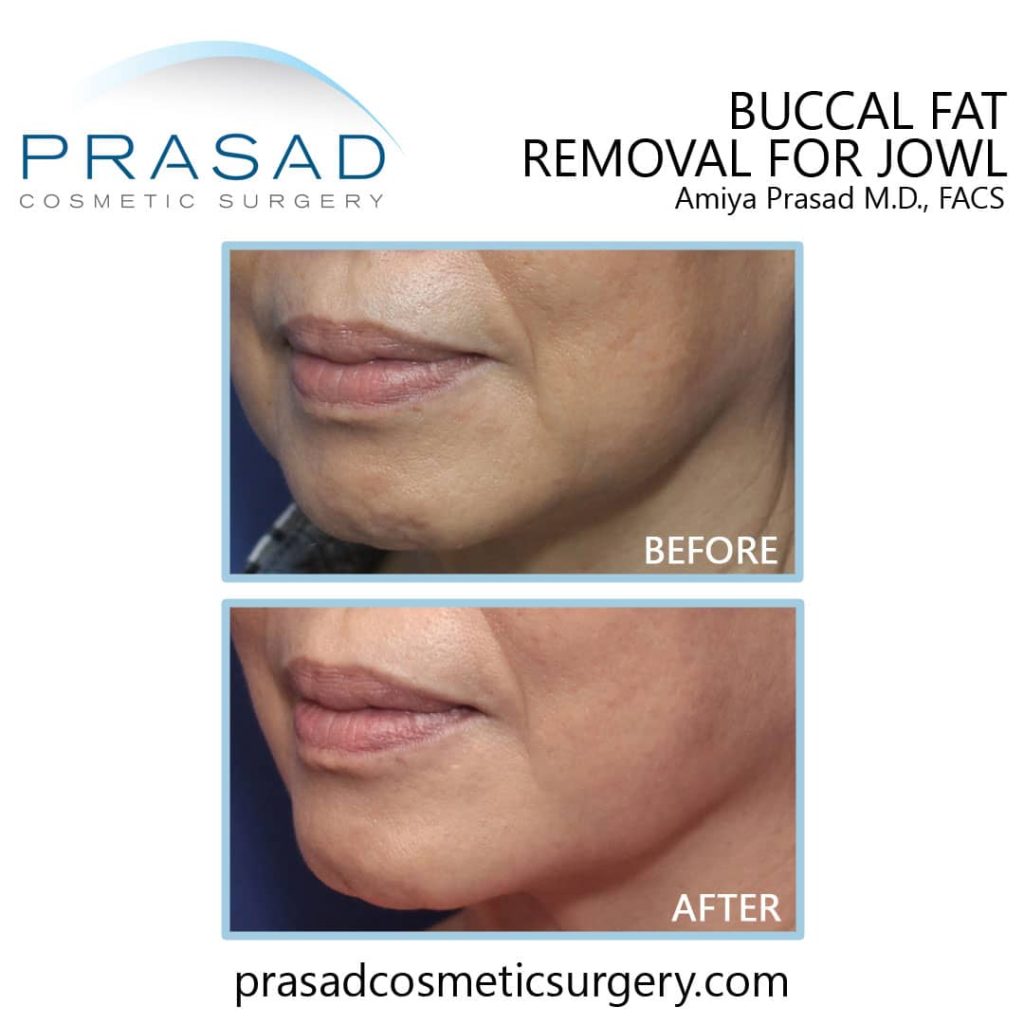 Buccal fat removal before and after Long Island, New York