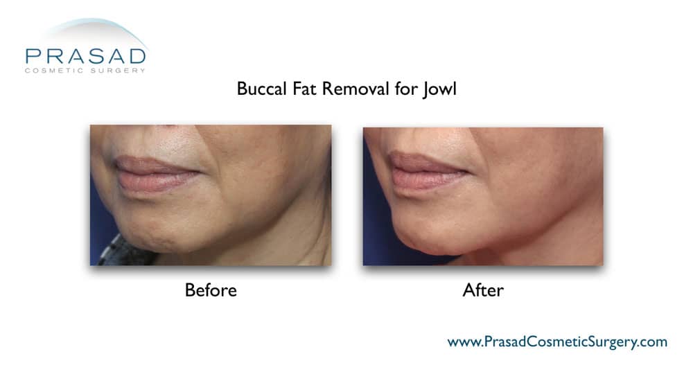 Buccal fat removal before and after NYC