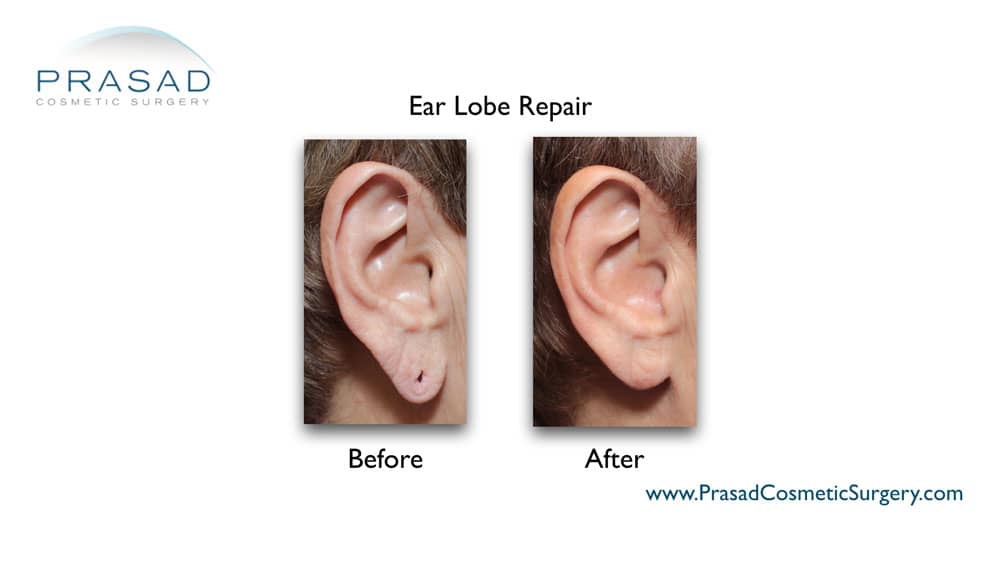 torn earlobe repair surgery before and after