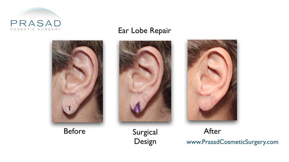 before and after earlobe repair at Prasad Cosmetic Surgery Manhattan NYC
