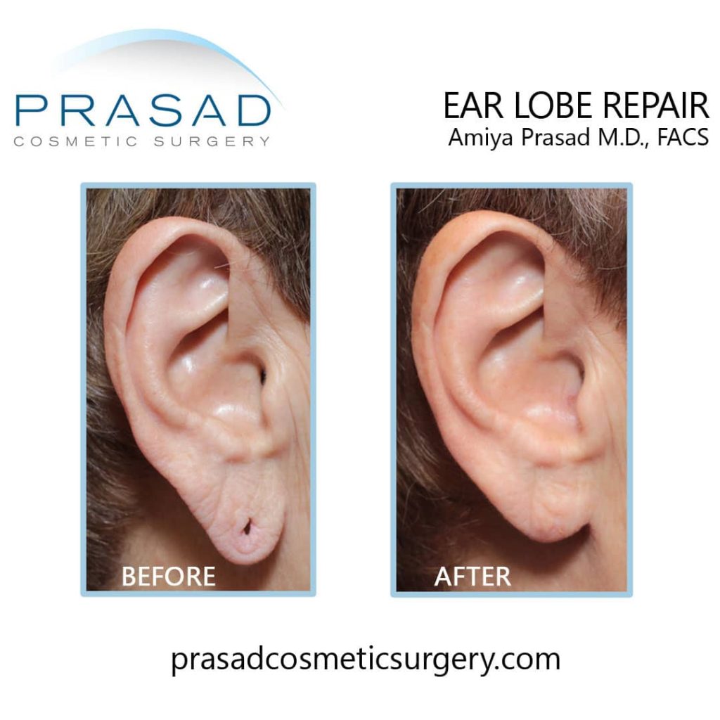torn ear lobe repair surgery before and after