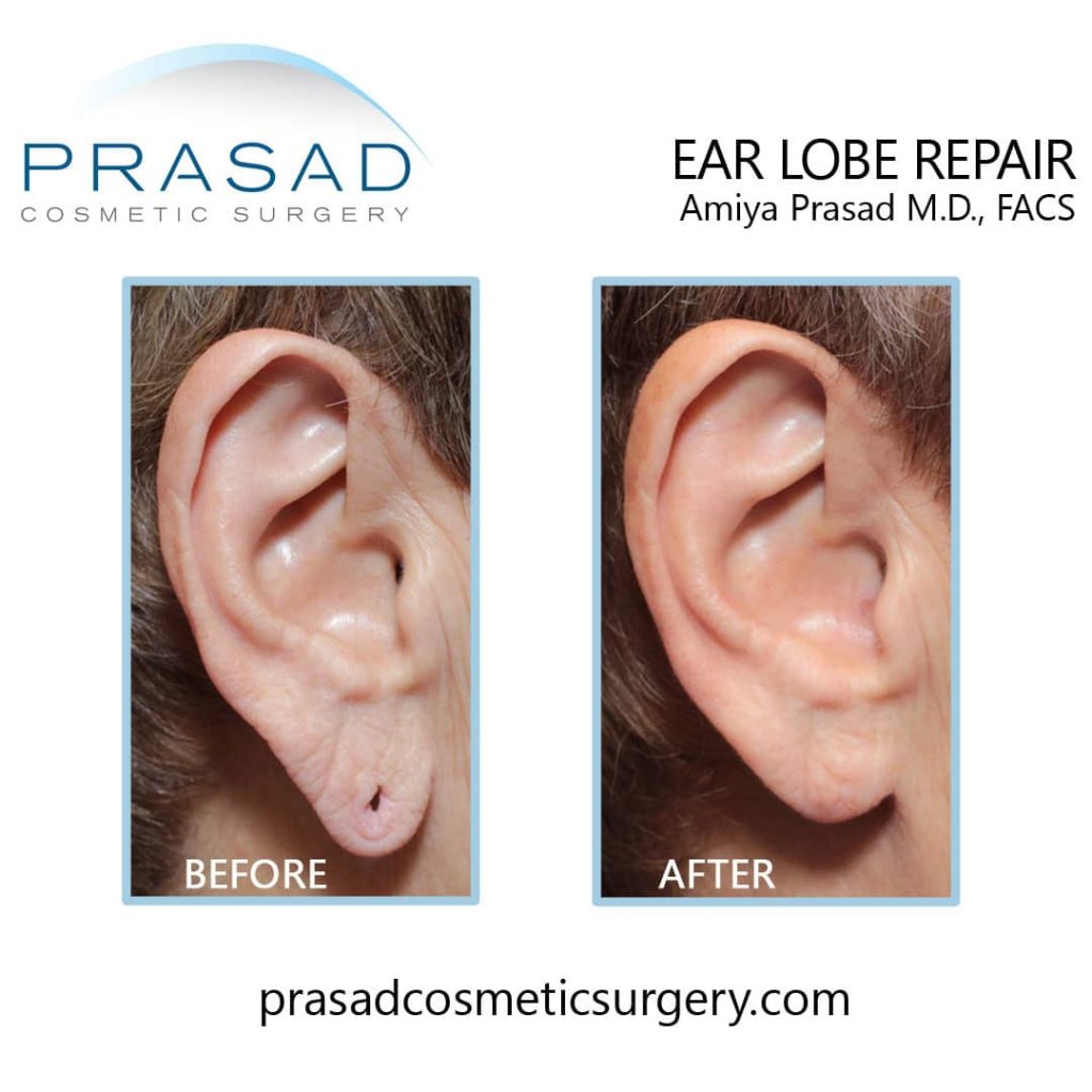 Repairing Gauge or Stretched Earlobes with Plastic Surgery