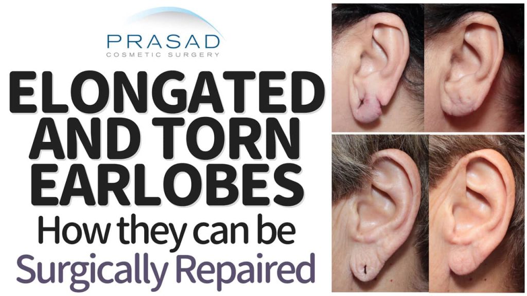 stretched or torn ear lobe repair