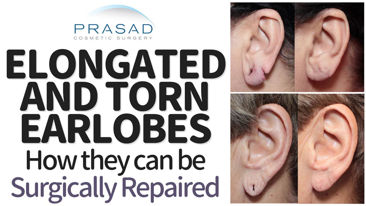 Torn or stretched ear lobes a problem? Don't worry, we have a