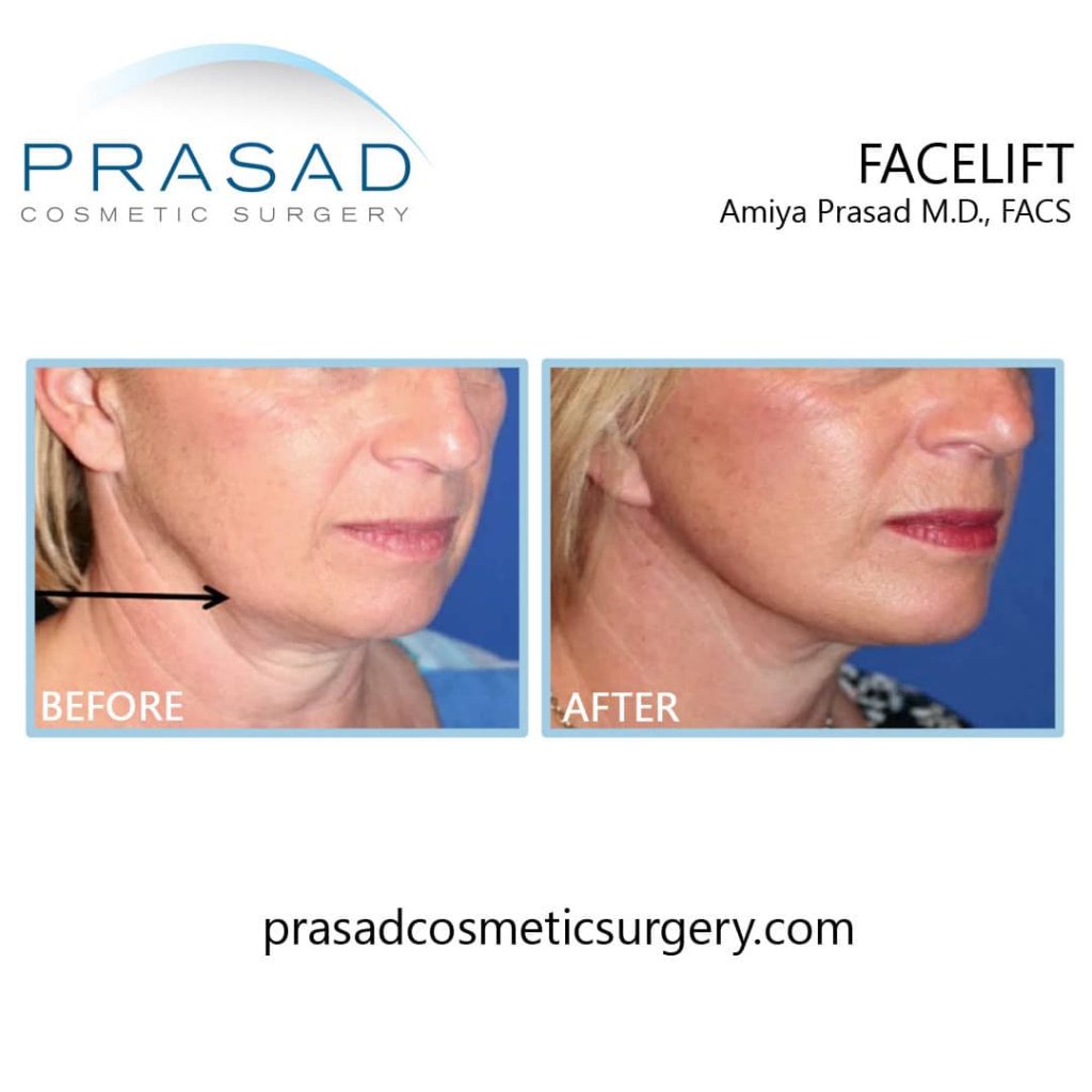 lower facelift surgery for jowl treatment before and after