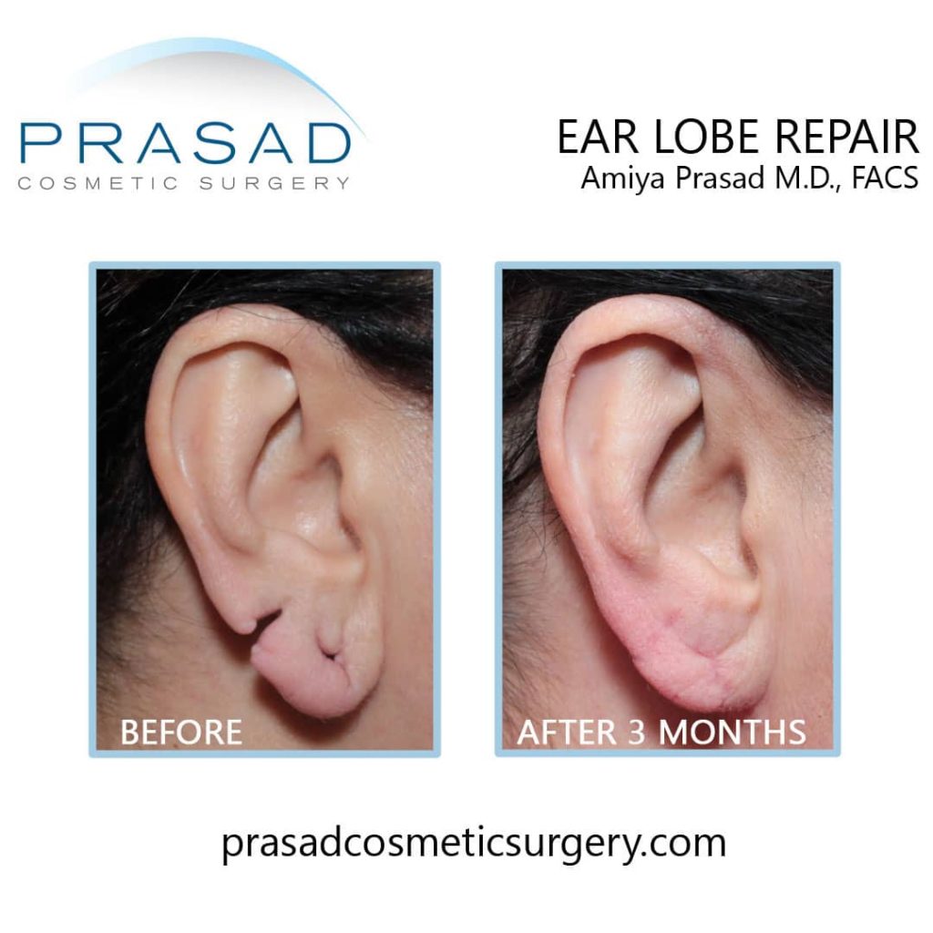 before and after split earlobe repair at Prasad Cosmetic Surgery Manhattan NYC