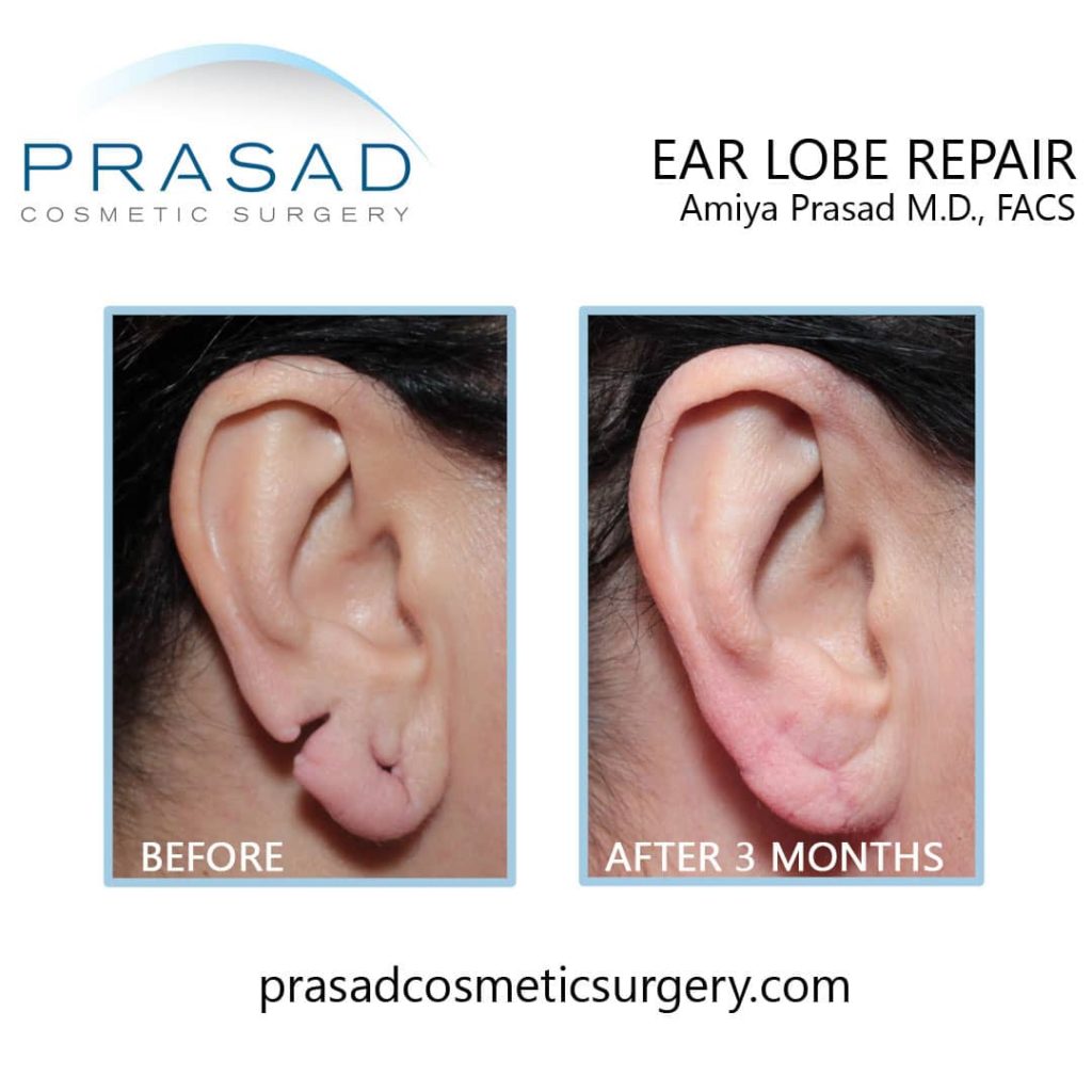 Can Stretched Or Torn Earlobes Be Repaired Dr Prasad Blog 6503