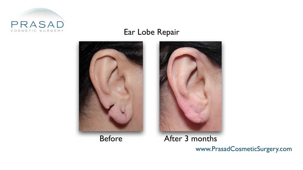 split earlobe repair before and after at Prasad Cosmetic Surgery Garden City Long Island