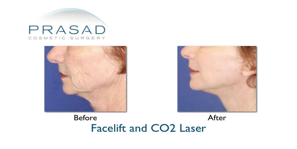 surgical facelift and facial laser skin tightening before and after