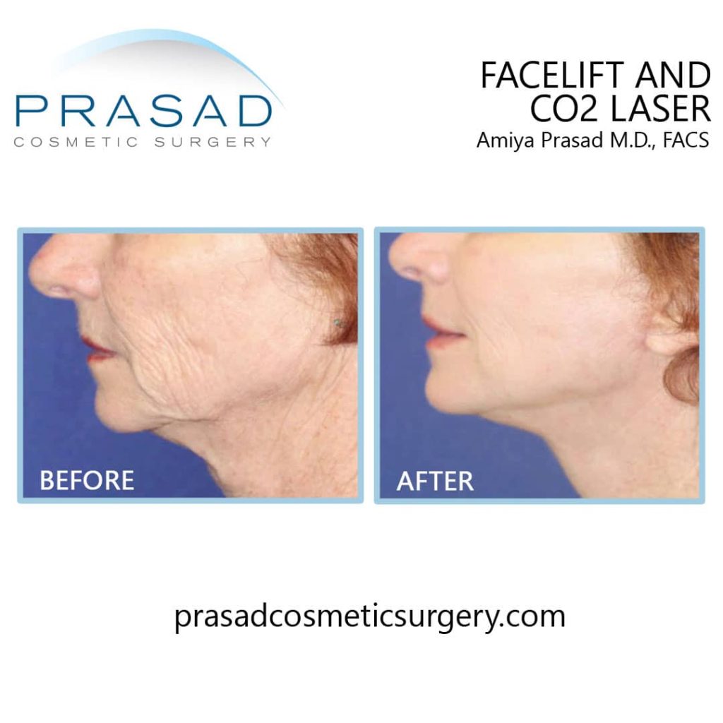 surgical facelift and facial laser treatment before and after