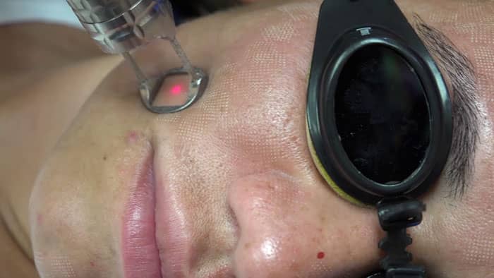 fractional laser demo