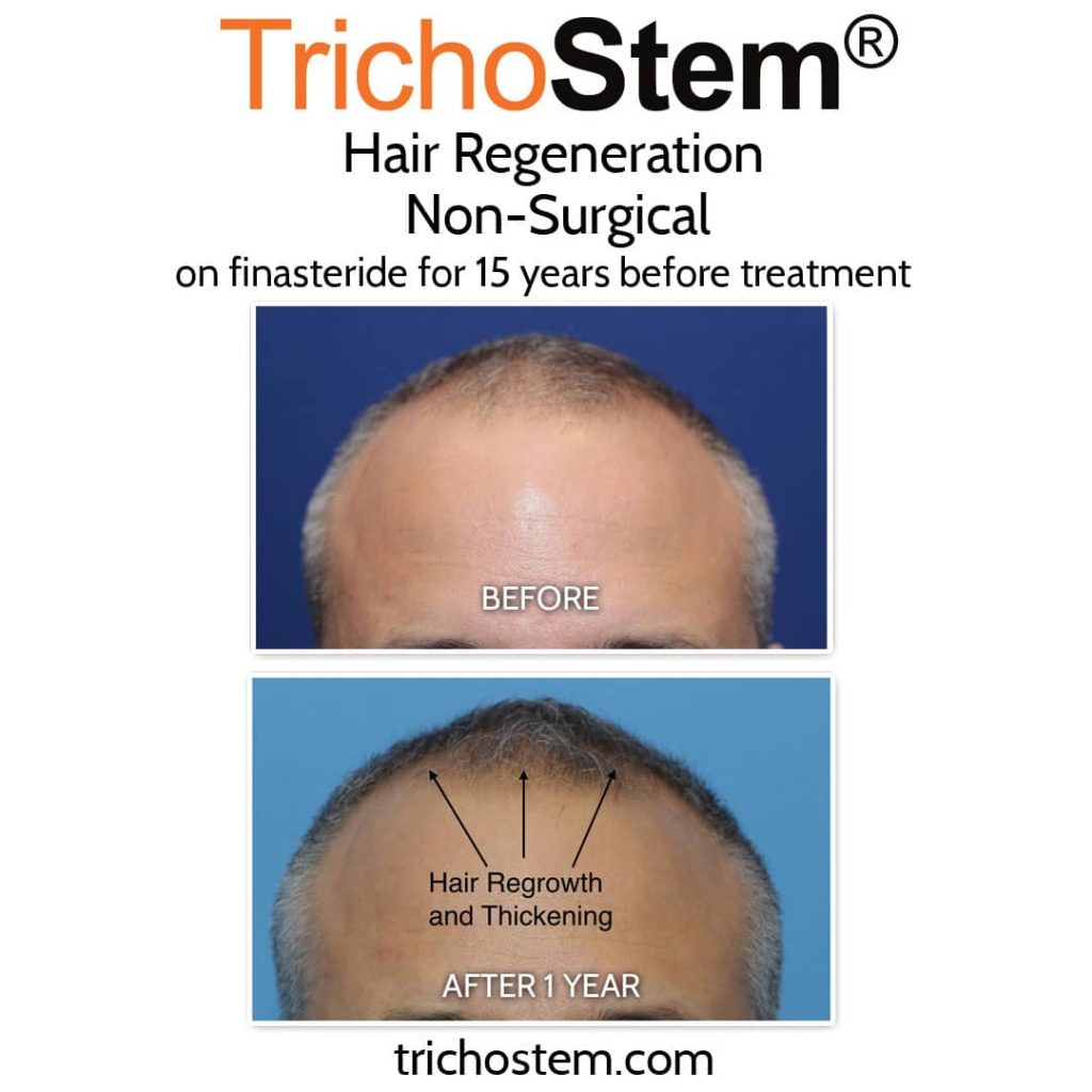 Trichostem Hair Regeneration treatment and finasteride together before and after results.