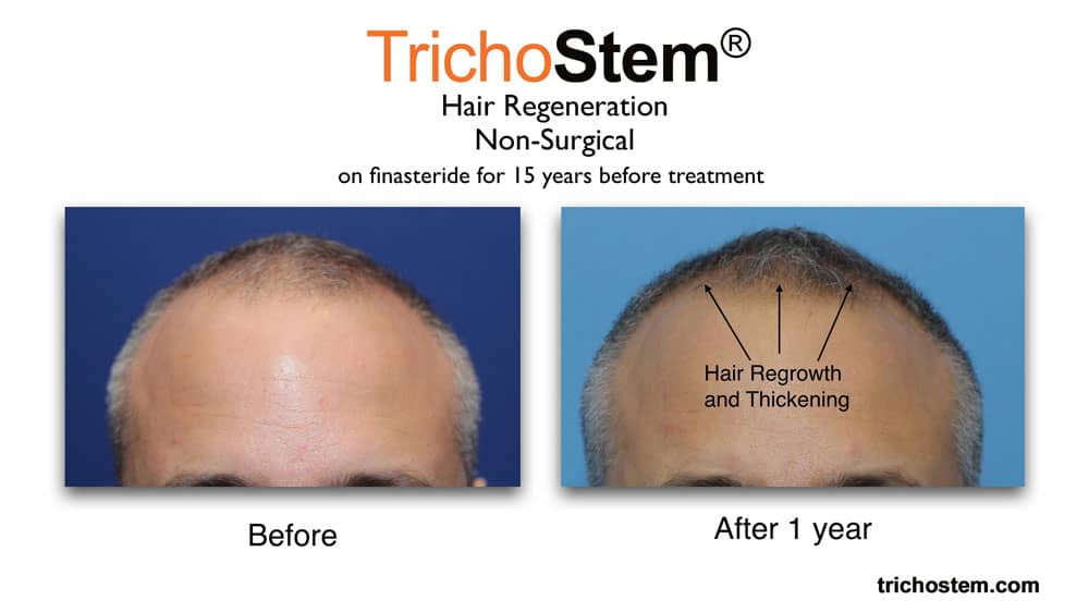 Trichostem Hair Regeneration treatment before and after. Patient in late 40s using finasteride for 15 years before treatment.